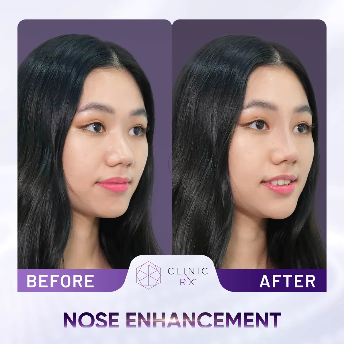 Nose Thread Lift actual result 3