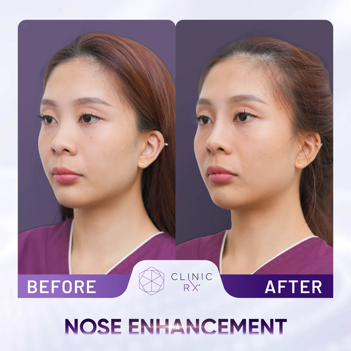 Nose Thread Lift actual result 5