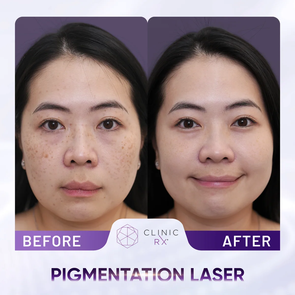 Pico Laser actual result 5