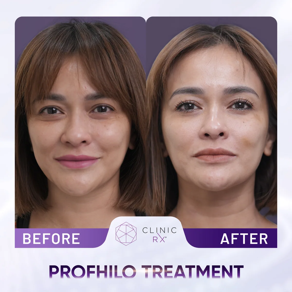 Profhilo actual result 1