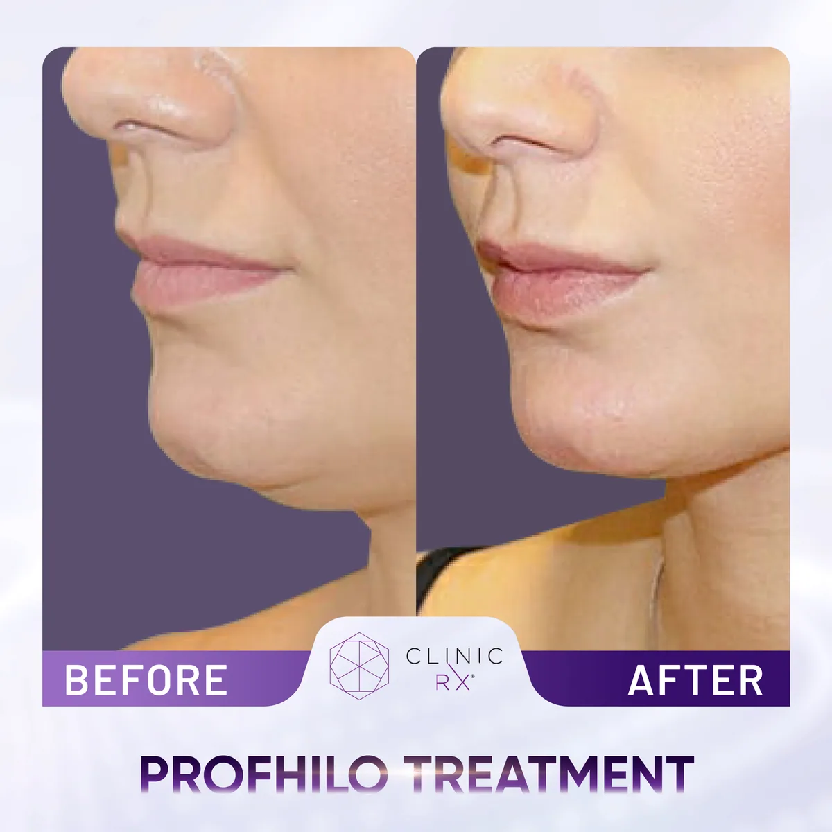 Profhilo actual result 4
