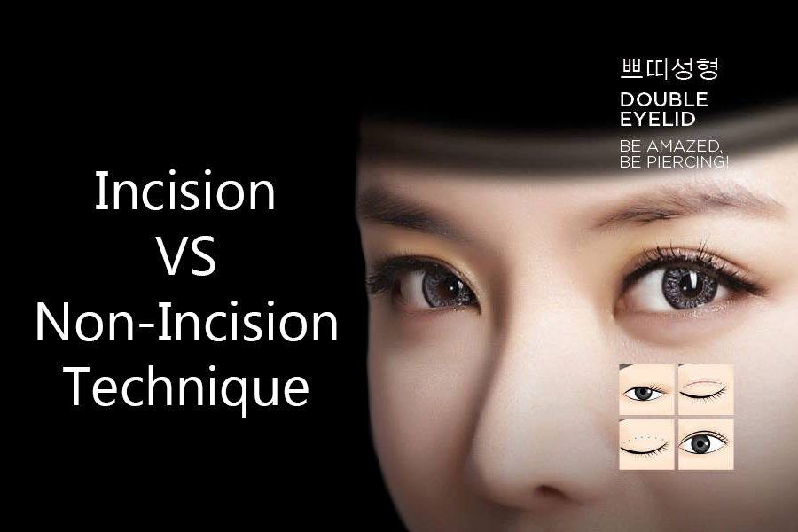 5 Differences between Incisional and Non-incisional Double Eyelid Surgery