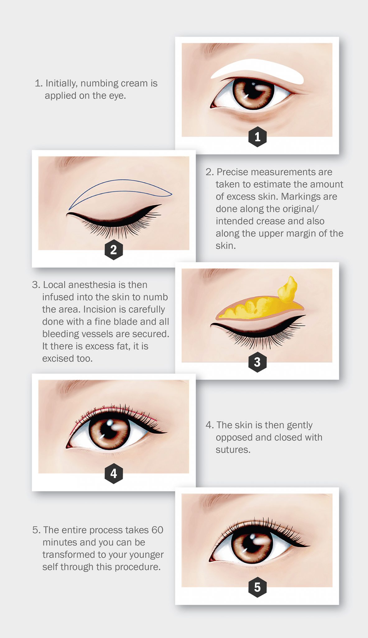 Upper Eyelid Surgery Clinic RX